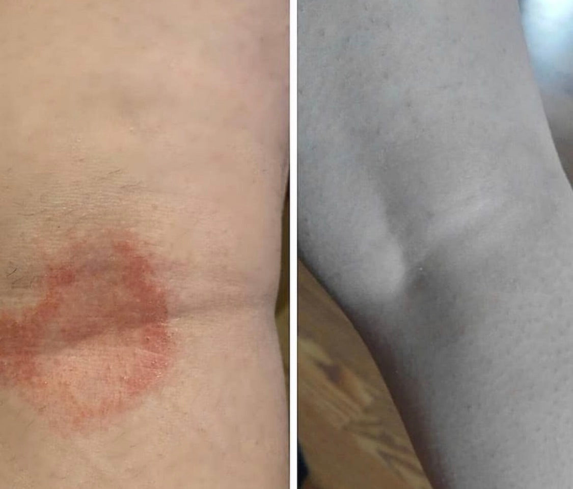 Eczema Relief Cream ( dry itchy skin )