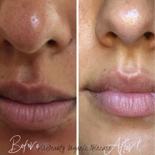 THE Blemish Buster Whipped Facial Cleanser