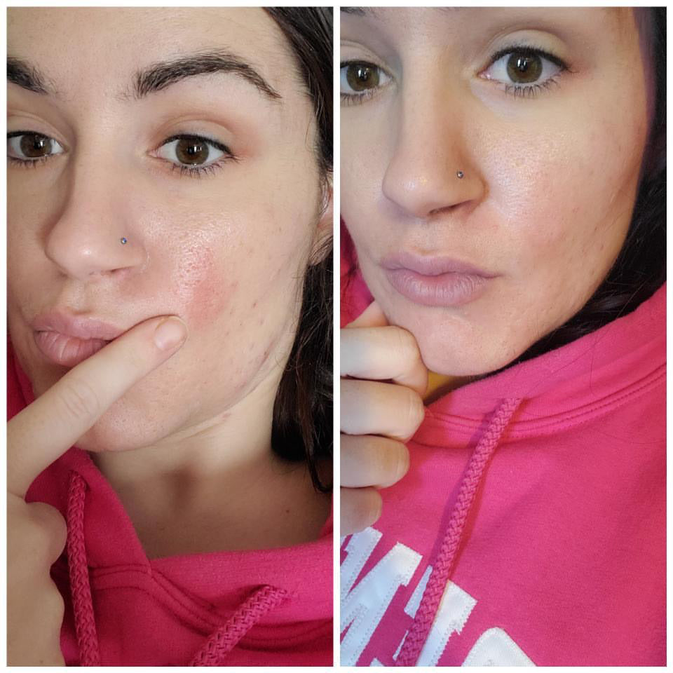 Eczema Relief Cream ( dry itchy skin )