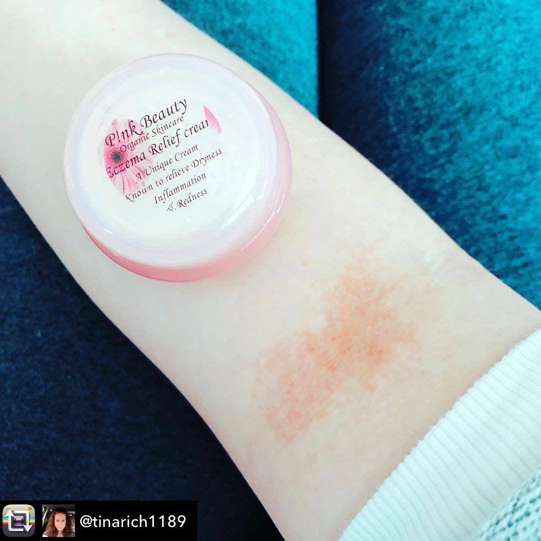 Eczema Relief Cream ( dry itchy skin )