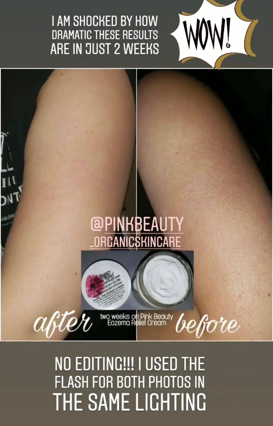 Eczema Relief Cream ( dry itchy skin )