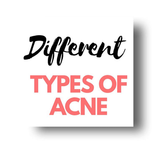 Acne types & treatment