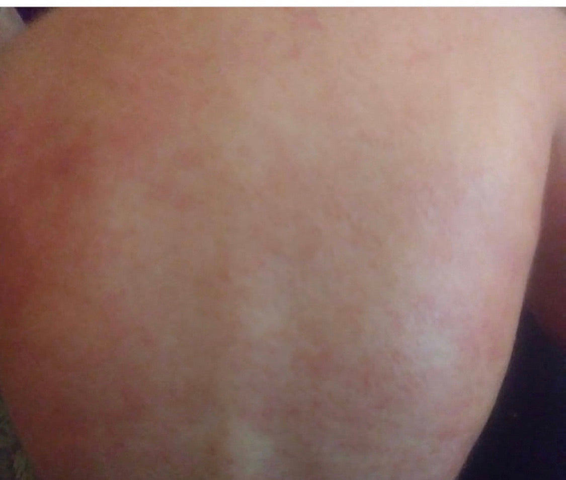 Eczema Relief Cream ( dry itchy skin )